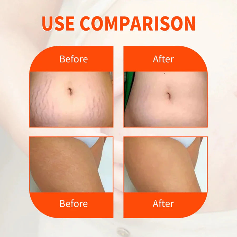 Bio-Oil Skincare Oil Stretch Marks Acne/Pimple Scar/Old/Scars Remover Removal Ageing Skin 200ML