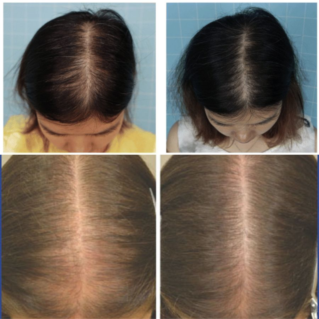 Rogaine Women's 2% Minoxidil Topical Solution for Womens Hair Thinning and Loss & Hair Regrowth 3-Month Supply