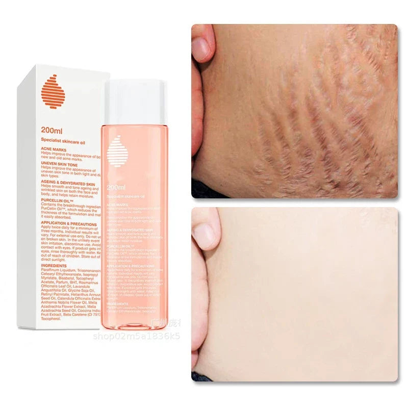 Bio-Oil Skincare Oil Stretch Marks Acne/Pimple Scar/Old/Scars Remover Removal Ageing Skin 200ML