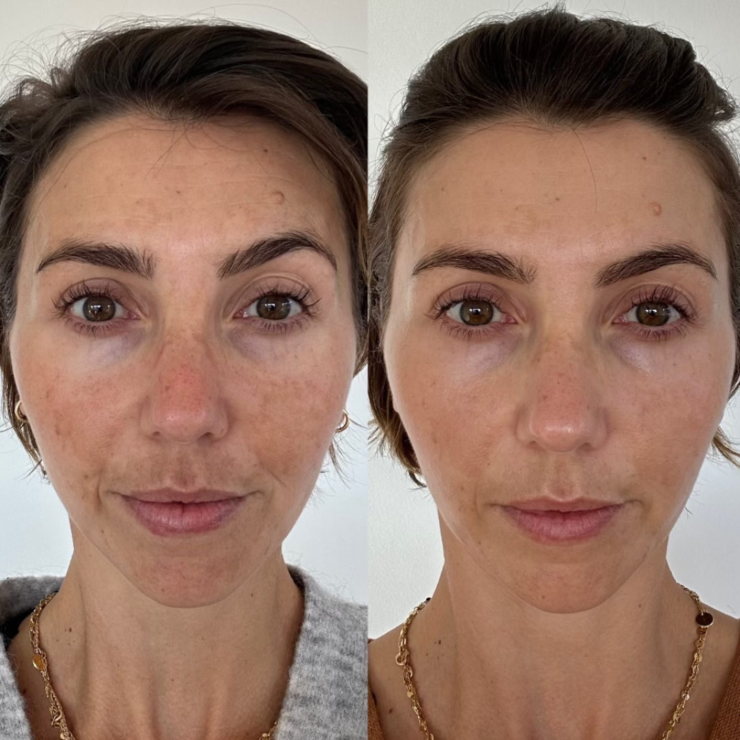 Combo Set – For Melasma, Pigmentation, and Dark Spots Gone! - Modarak UAE