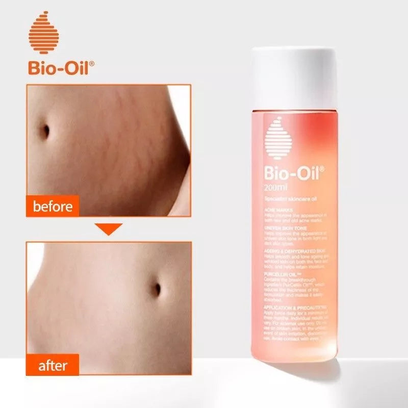 Bio-Oil Skincare Oil Stretch Marks Acne/Pimple Scar/Old/Scars Remover Removal Ageing Skin 200ML