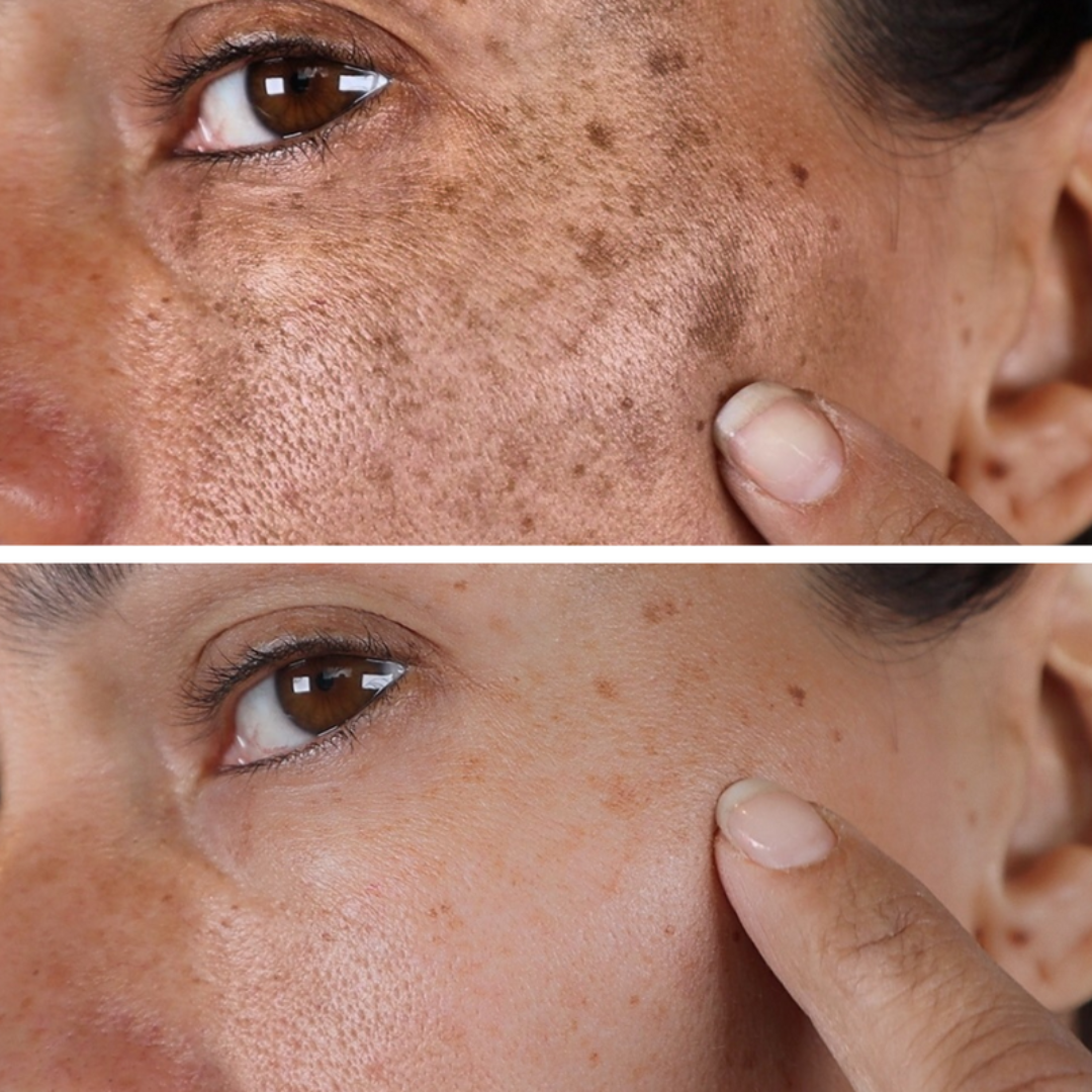 Combo Set – For Melasma, Pigmentation, and Dark Spots Gone! - Modarak UAE