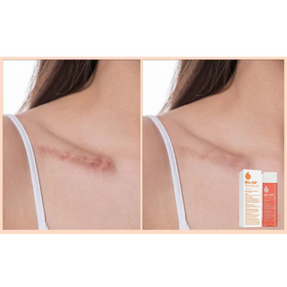 Bio-Oil Skincare Oil Stretch Marks Acne/Pimple Scar/Old/Scars Remover Removal Ageing Skin 200ML